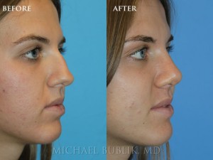 Clinical history: Patient underwent nose reshaping ("rhinoplasty") for a severely deviated crooked nose and septum and nasal hump. She now has a straight side and front profile and is able to breath well through a natural feminine appearing nose.
