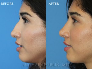 Clinical History: This is a 26 year old woman who wasn’t happy with the appearance of her nose and underwent cosmetic and functional rhinoplasty (nose job). You can see from her smiling view that her nose no longer "droops." She also had a badly deviated septum which made it impossible for her to breathe from one side. She had trouble sleeping and also had continued infections because of inability to move air and clear her nose and sinuses.