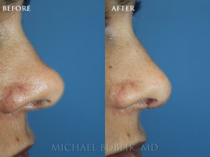 Clinical history: This patient presented with long "Pinocchio" nose and wanted a more natural shorter "de-projected" nose. She had a beautiful and natural result. We make your nose look the way you want it to look. We don't believe in the "cookie-cutter" rhinoplasty. 