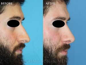 Clinical history:  Male rhinoplasty (nosejob). This patient had a crooked nose, droopy tip and nasal bridge bump as well as severe breathing difficulty. He was very happy with the natural resul which is especially important for male patients.