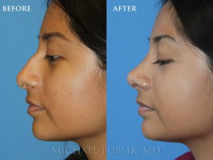 Clinical History: This young lady underwent cosmetic rhinoplasty ("nosejob") for a droopy and wide tip and large bump on the bridge of the nose.  I smoothed out the bump and refined her top to get a beautiful result.