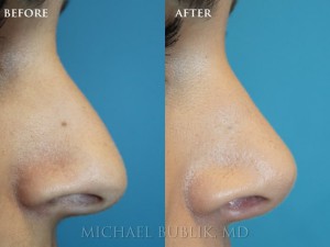 This is a 3 year follow up on a patient who had rhinoplasty (nose reshaping).  She presented with a wide and droopy nasal tip with nasal bump.  She achieved a beautiful result that is natural, feminine and stunning.