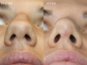 Clinical history: Patient underwent nose reshaping ("rhinoplasty") for a severely deviated crooked nose and septum and nasal hump. She now has a straight side and front profile and is able to breath well through a natural feminine appearing nose.