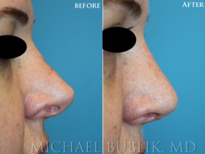 Patient was unhappy with an over-rotated, over-projected nasal tip and bridge deformity. She underwent revision external rhinoplasty for a more natural appearing nose.