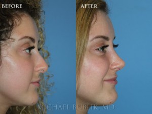 Clinical history: This patient underwent nose reshaping ("rhinoplasty") for a droopy tip, nasal bump and wide nose. You can see that her nose is now feminine, natural and elegant. She has a nice natural feminine scoop to the nose and the tip no longer drops down on the frontal view.