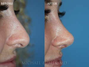 Clinical history: This patient underwent nose reshaping ("rhinoplasty") for a droopy tip, nasal bump and wide nose. You can see that her nose is now feminine, natural and elegant. She has a nice natural feminine scoop to the nose and the tip no longer drops down on the frontal view.