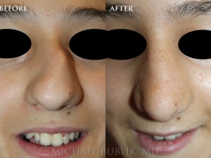 Clinical History: This is a 13 year old female who was born with a severely deviated septum, crooked nose and significant dorsal hump. She had a septoplasty and rhinoplasty ("nose job") and now has a naturally appearing nose and for the first time in her life can now breath through her nose.