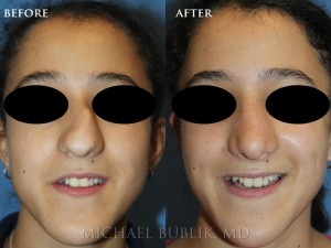Clinical History: This is a 13 year old female who was born with a severely deviated septum, crooked nose and significant dorsal hump. She had a septoplasty and rhinoplasty ("nose job") and now has a naturally appearing nose and for the first time in her life can now breath through her nose.