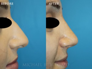 Clinical History:  Incision-less rhinoplasty (no external scars) with excellent profile (side view) alignment without swelling or external scars.  Patient was unhappy with the dorsal bump and droopy tip.   