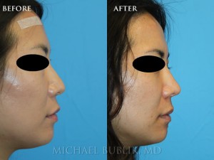 Clinical History: This young Asian American female desired a more western nose. She complained of droopy nasal tip, dorsal bump and wide tip.   She also had breathing difficulty and sinus issues and underwent external rhinoplasty, septoplasty, and turbinate reduction to help with her cosmetic and functional nasal concerns. Her results shows a natural appearing nose which is more refined, has more tip definition and strength and more of a supra-tip break giving her more of a feminine appearing nasal profile. 