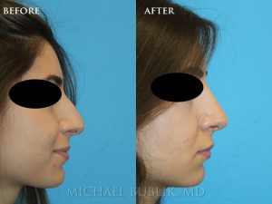 Clinical History: This young woman wanted to have her tip refined, large bump improved as well as a more elegant nose for a more balanced facial appearance. She also had difficulty breathing and sinus infections. She underwent rhinoplasty, septoplasty, and turbinate reduction. She wanted a straight profile with a minor supra-tip break. This means that the tip comes off the bridge of the nose slightly. The tip was also rotated upwards for a more feminine appearing nose. She was very happy with her result and it made her delicate facial features look even more refined without any drastic changes.