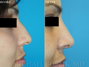 Clinical History: Healthy female with nasal hump, and wide nasal tip Procedures: Rhinoplasty with hump reduction (full osteotomies), and tip-plasty using dome unit sutures. Graft Types: Columellar strut.