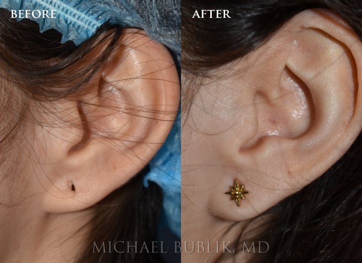 Ear Lobe Repair - Los Angeles