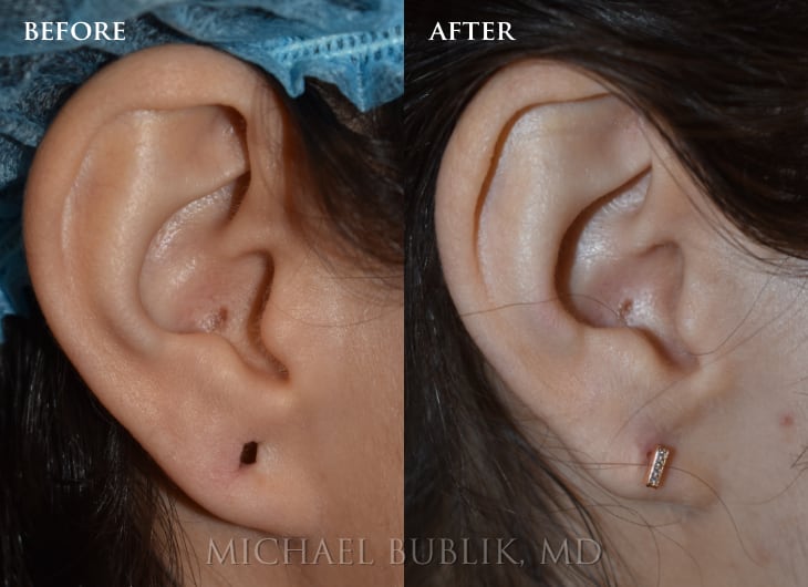 Ear Lobe Repair - Los Angeles