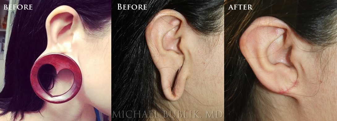 Ear Lobe Repair - Los Angeles