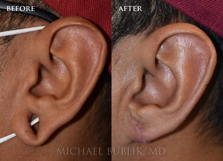 Ear Lobe Repair - Los Angeles