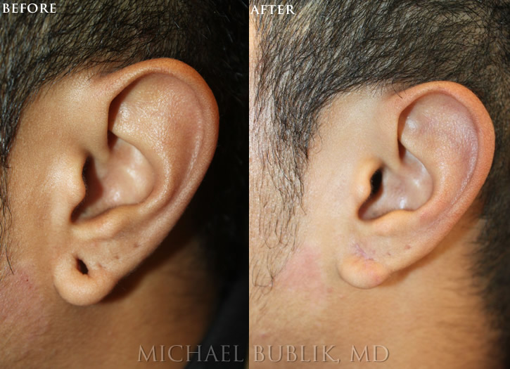 Ear Lobe Repair - Los Angeles