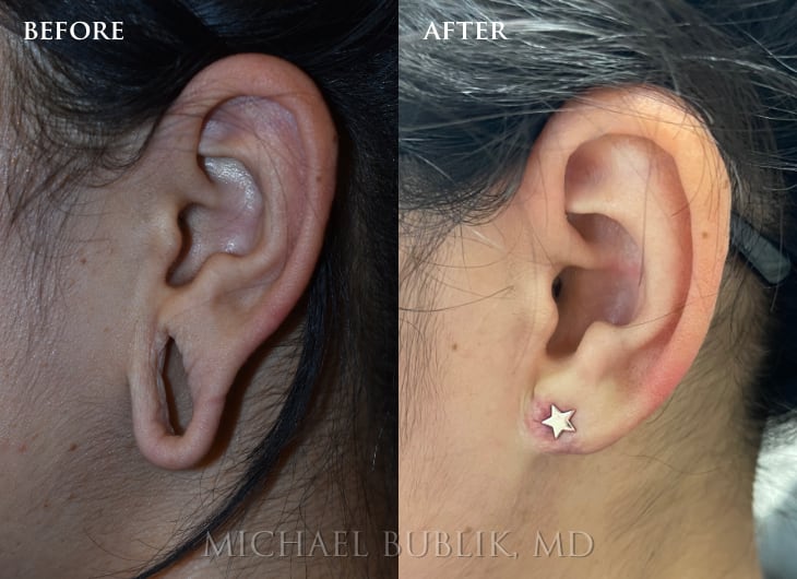 Ear Lobe Repair - Los Angeles