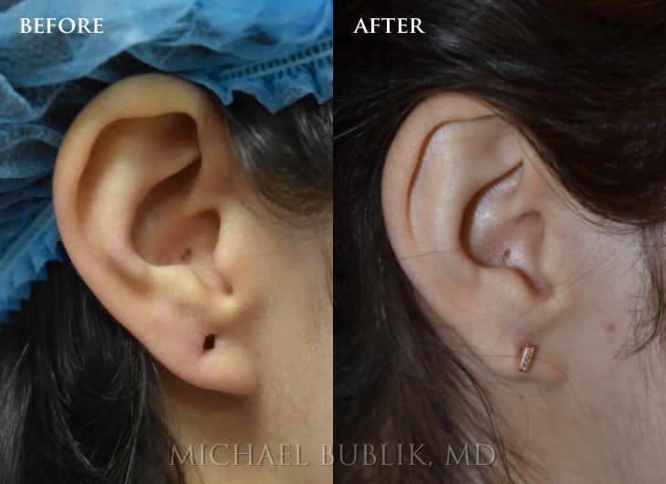 Ear Lobe Repair - Los Angeles