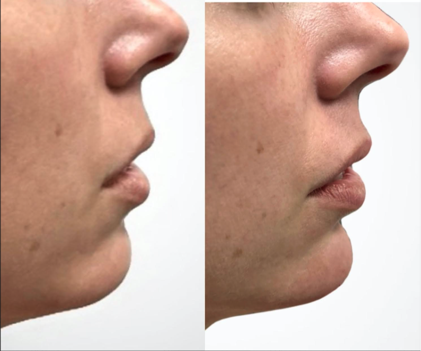 Chin & Jaw Line Filler Los Angeles